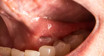 Leukoplakia